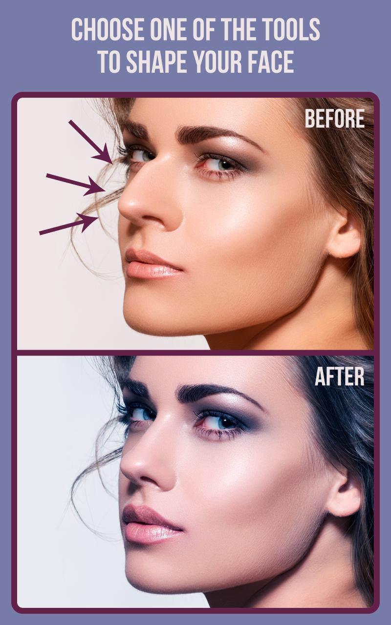 Rhinoplasty